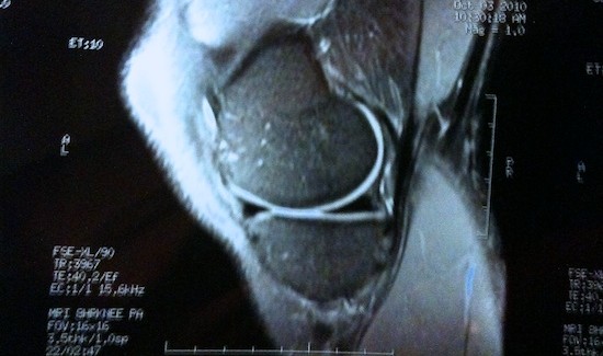 Knee MRI